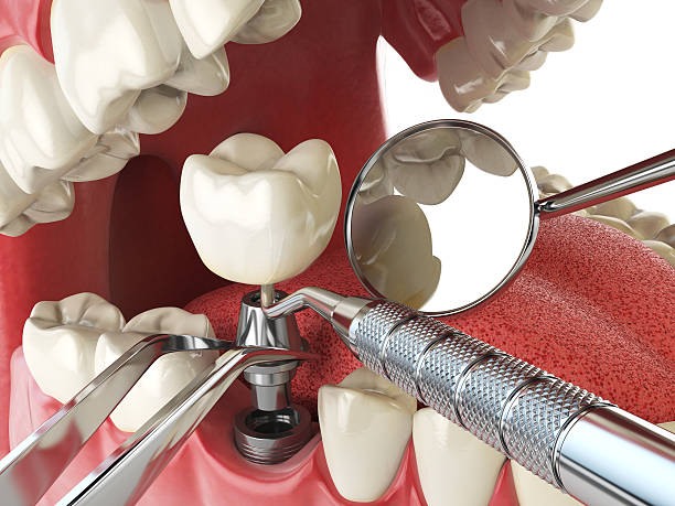Best Emergency Treatment for Dental Infections or Abscesses in Salem, AR